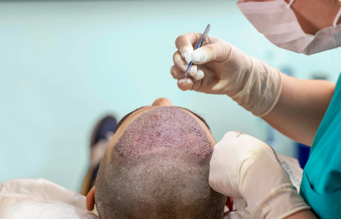 BIO FUE Hair Transplant