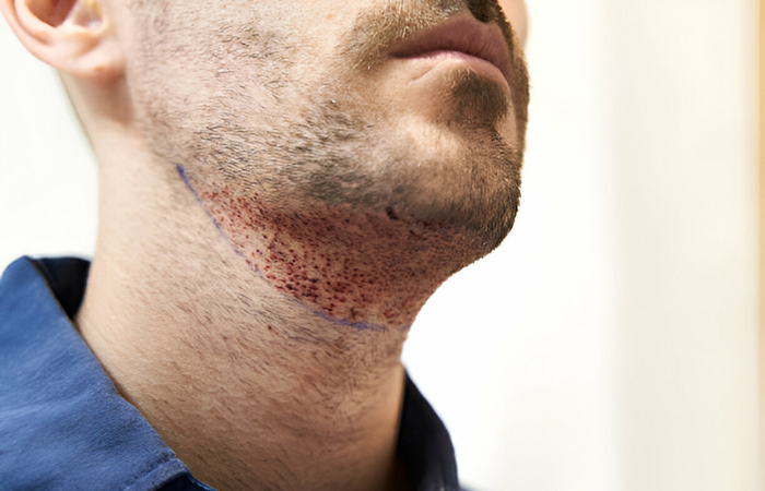 Beard Hair Transplant