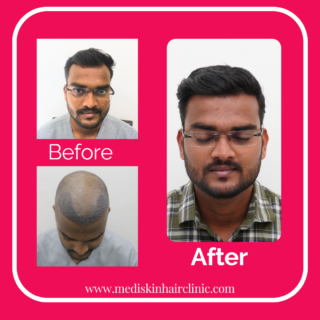 Before-8-Copy-320x320