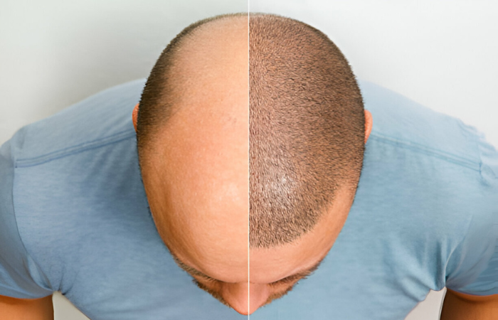 Affordable Hair Transplant in Kharadi | MediSkin Clinic