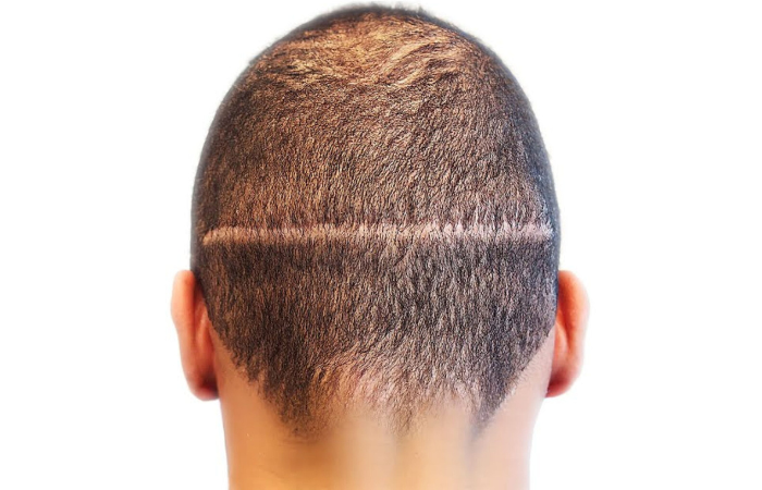 FUT Hair Transplant